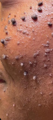 Before facial skin growth treatment