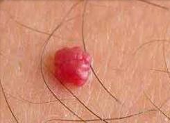 Cherry angioma example