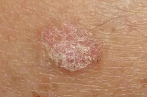 Wart example