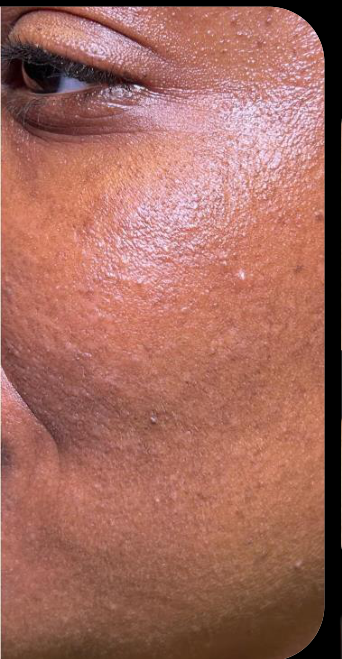 After facial skin growth treatment
