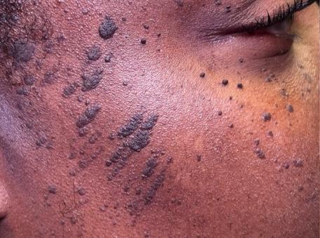 Seborrheic keratosis example