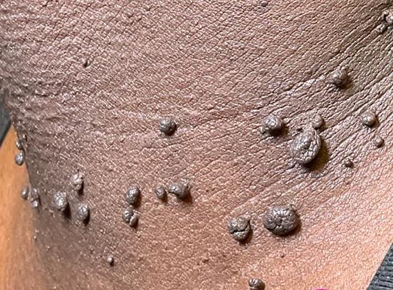 Skin tag example
