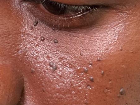Dermatosis papulosa nigra example