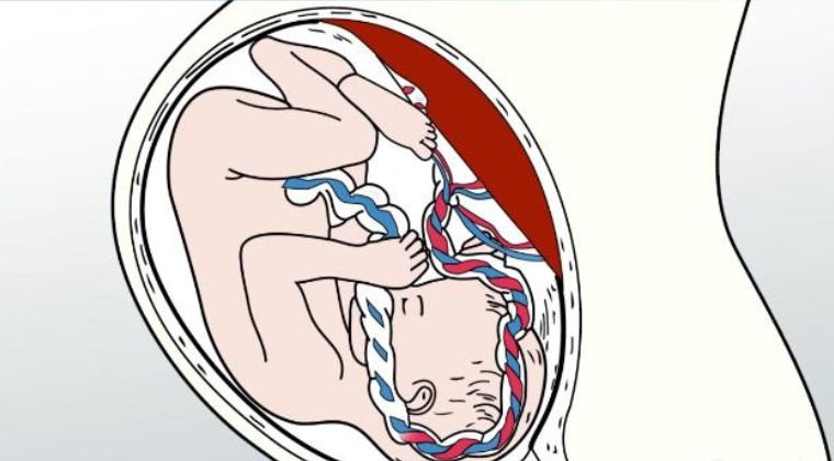 Blood Circulation between fetus and placenta through the umbilical cord (through 2 umbilical arteries and 1 umbilical vein)