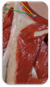 Σημείο trigger Point στον τραπεζοειδή μυ, που θα διδαχθεί στο σεμινάριο trigger Points, Acupressure και GuaSha– Αντιμετώπιση Οξέων καταστάσεων