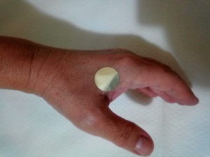 Σημείο στο χέρι που θα διδαχθεί για την αντιμετώπιση του πόνου στο Σεμινάριο Acupressure , Ηλεκτροβελονισμού, θεραπευτικής Acupressure Μάλαξης και GuaSha