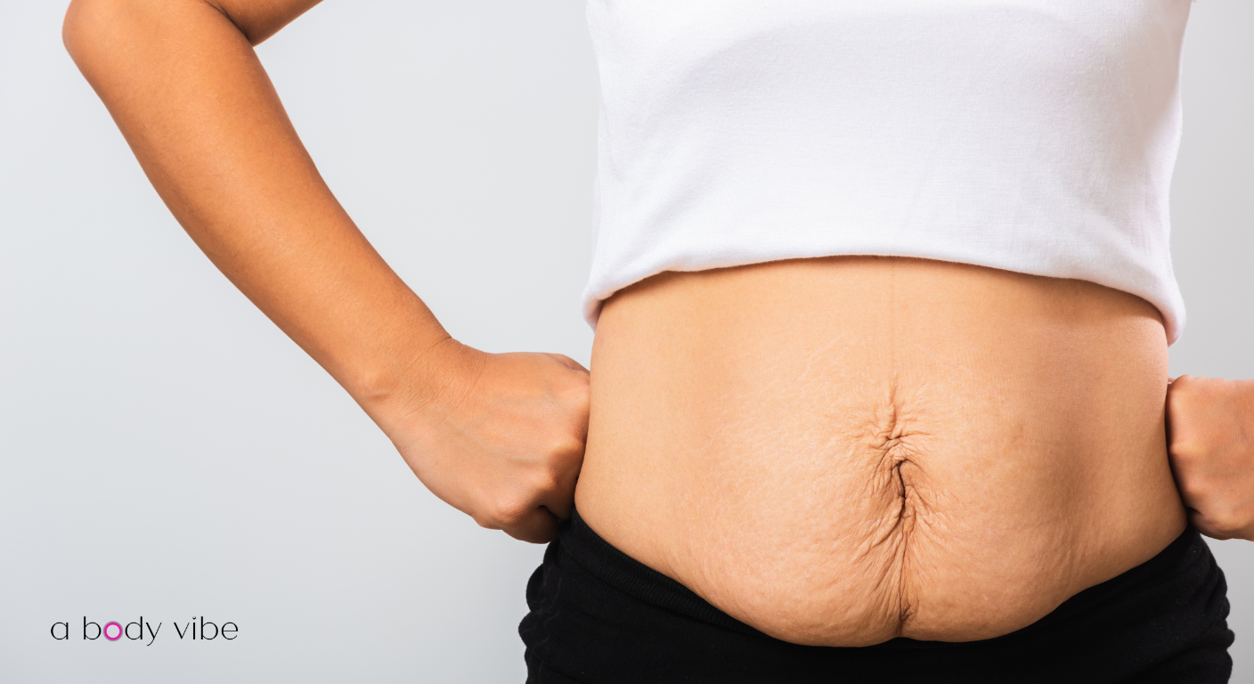 Radiofrequency skin tightening for loose skin after rapid weight loss