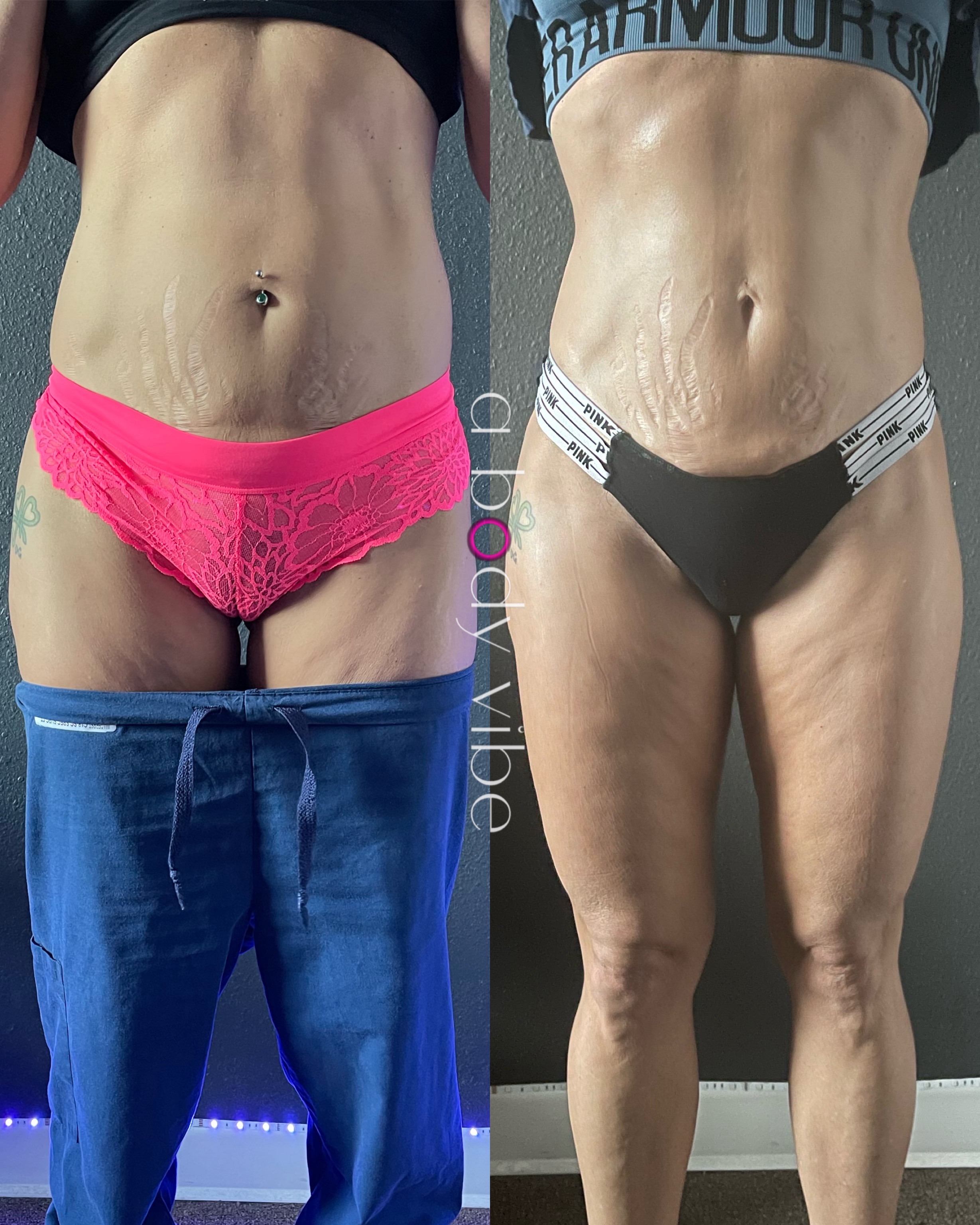 Before and after 3 wood therapy tightening sessions