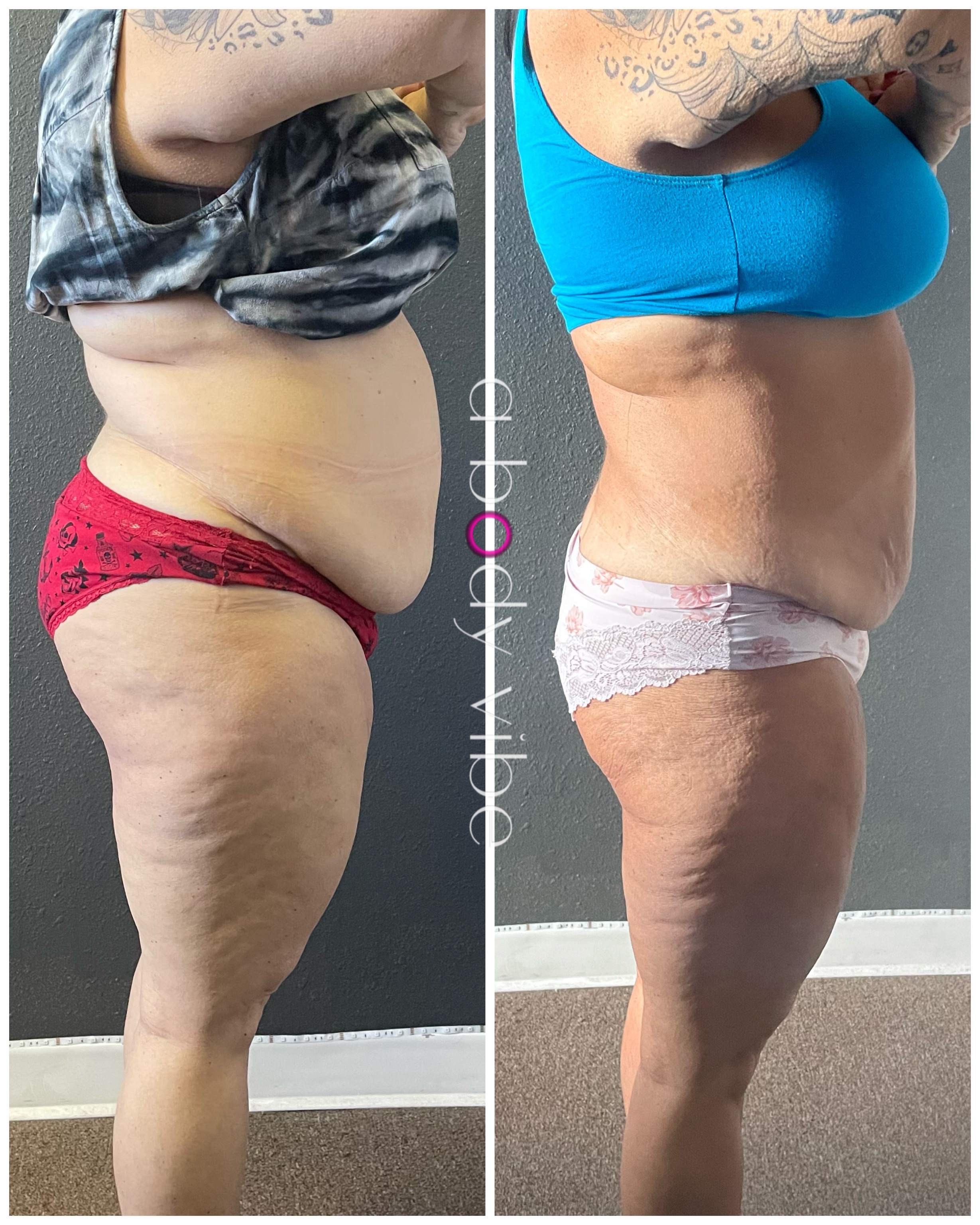 before and after results from noninvasive body contouring treatments