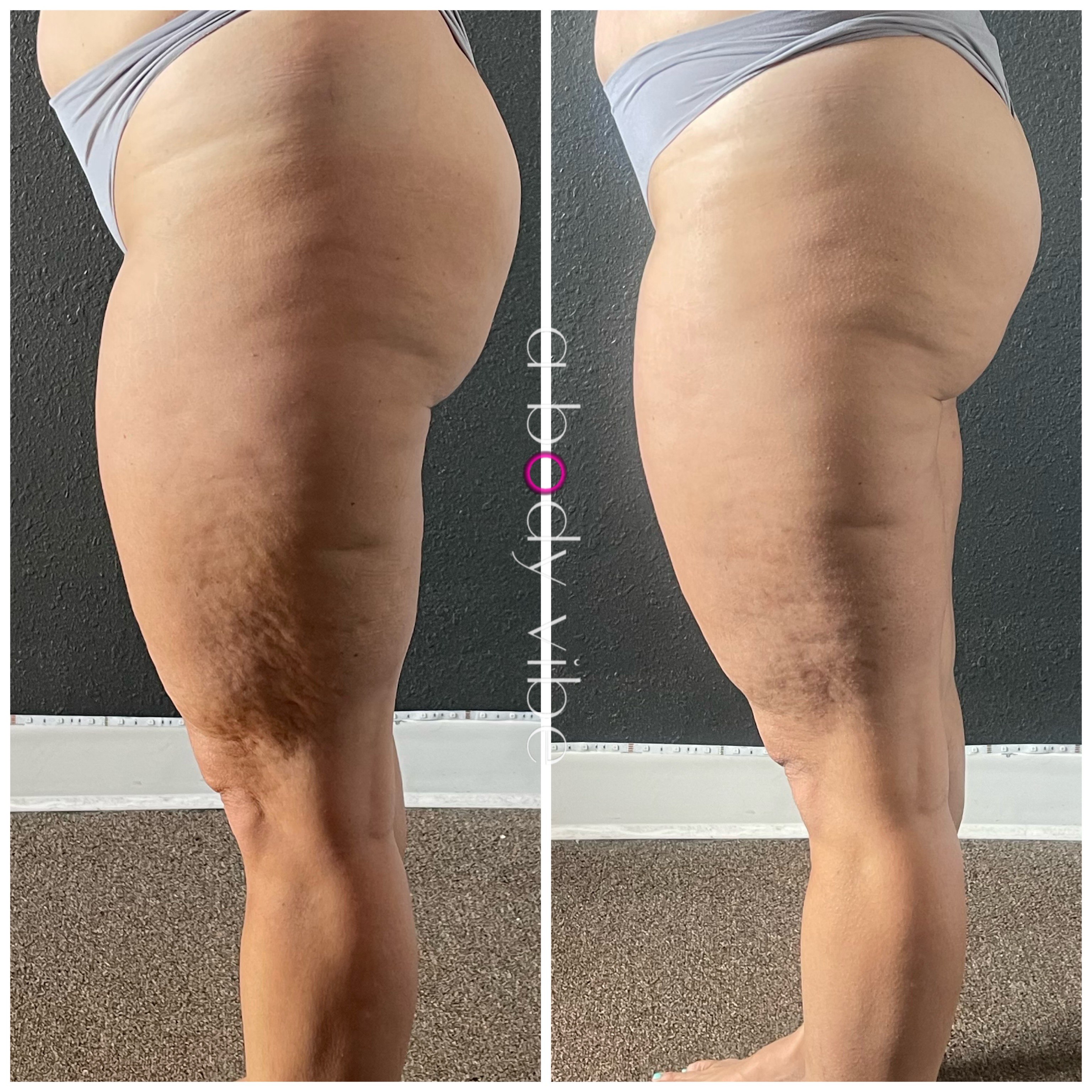 before and after results from a g5 cellulite treatment