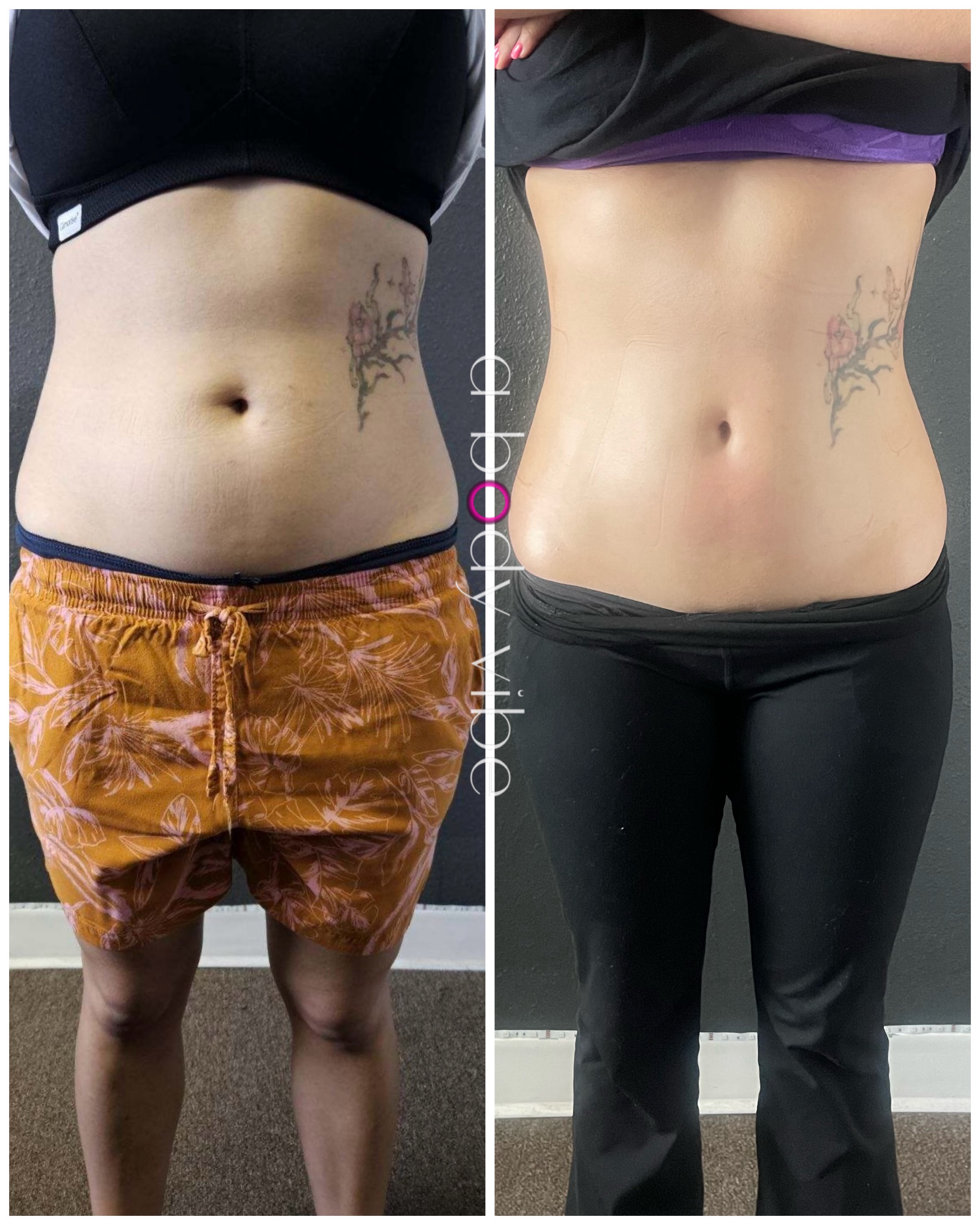 Before and after 3 customized noninvasive body contouring treatments