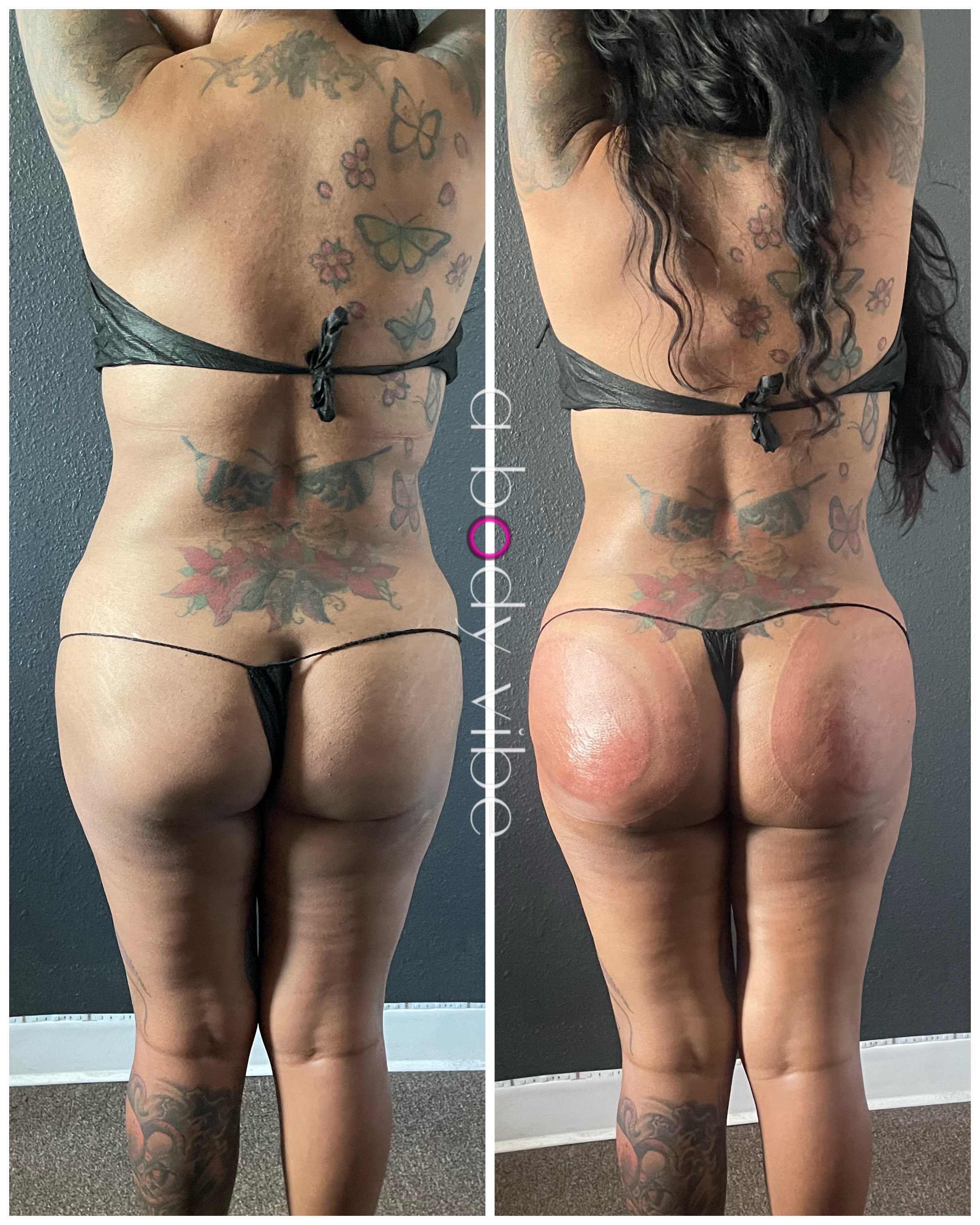 before and after results from noninvasive butt lifting and cellulite treatments