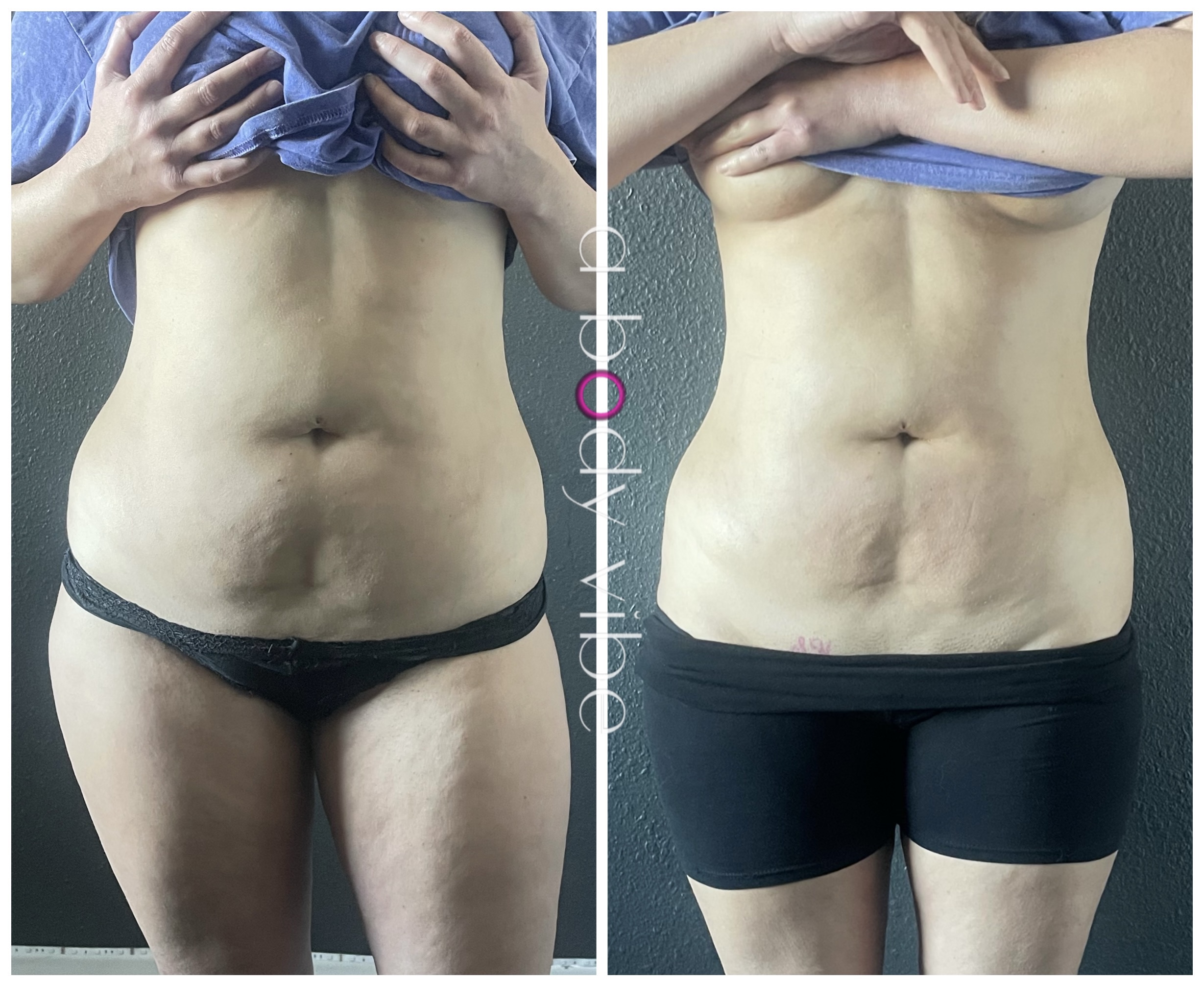 Before and after 1 noninvasive body contouring session