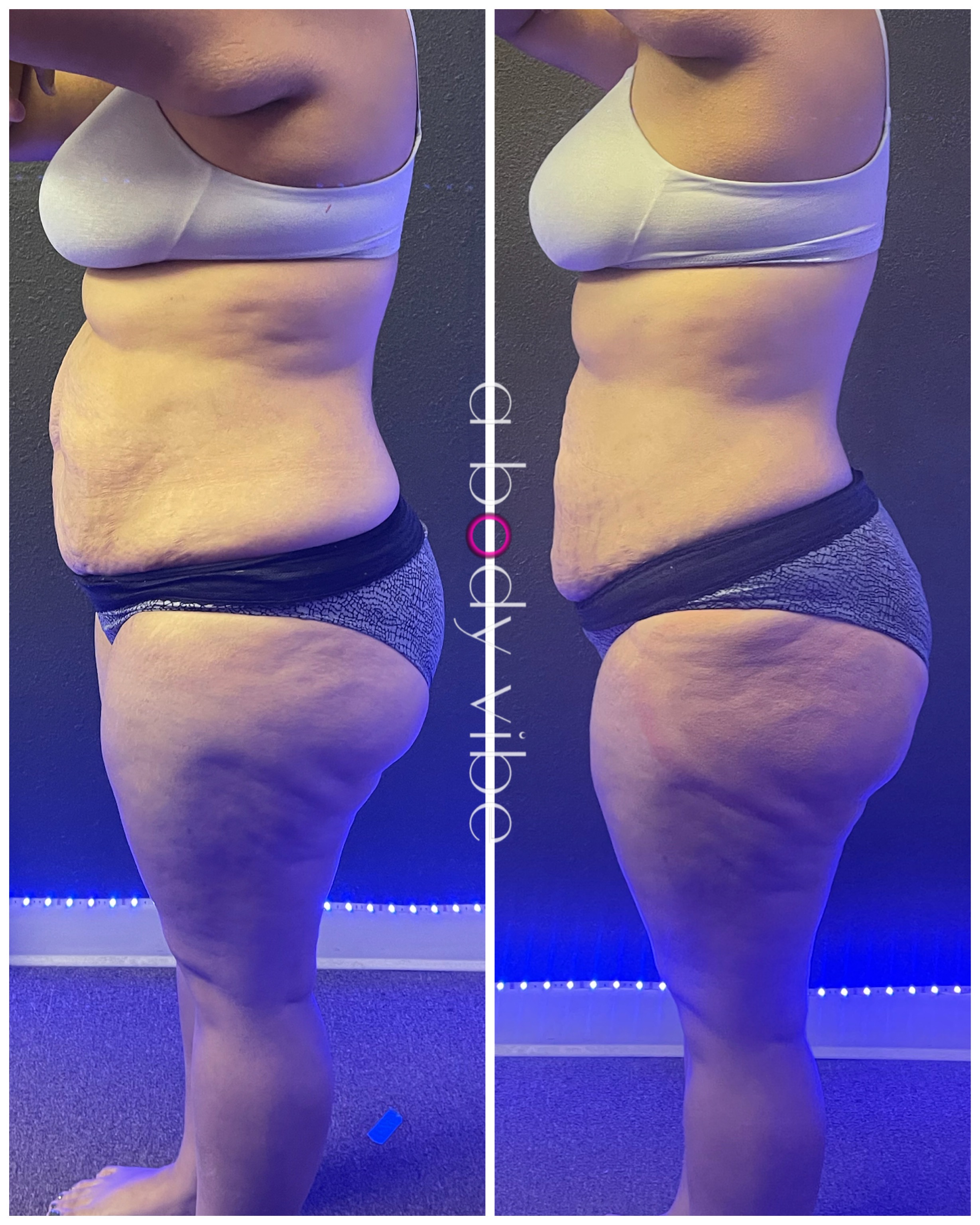 Before and after results for ultrasonic cavitation and radio frequency skin tightening treatments