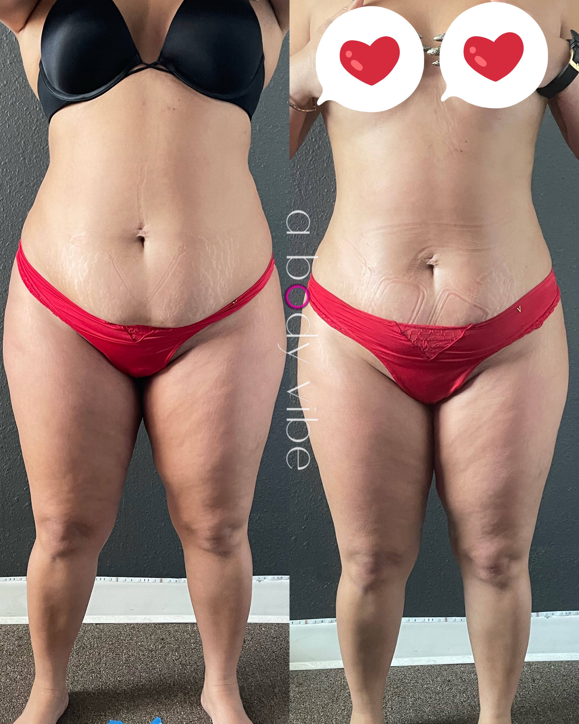 Before and after 1 customized body contouring session on the abdomen, focusing on lymphatic drainage