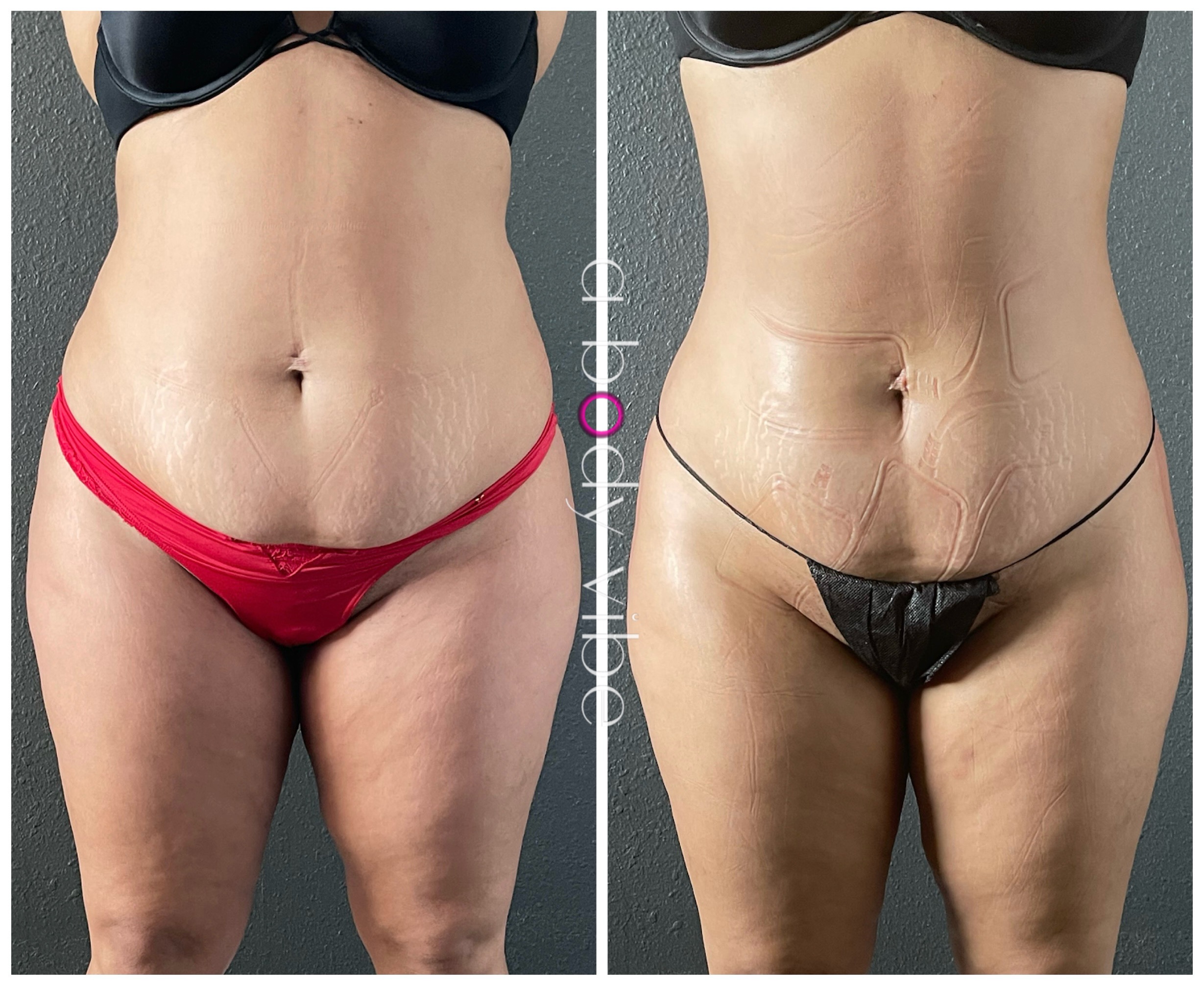 Before and after 4 customized noninvasive body contouring sessions