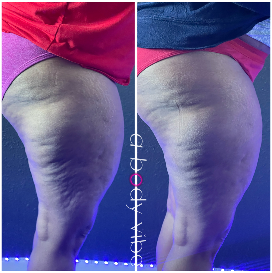 before and after results from a g5 cellulite treatment