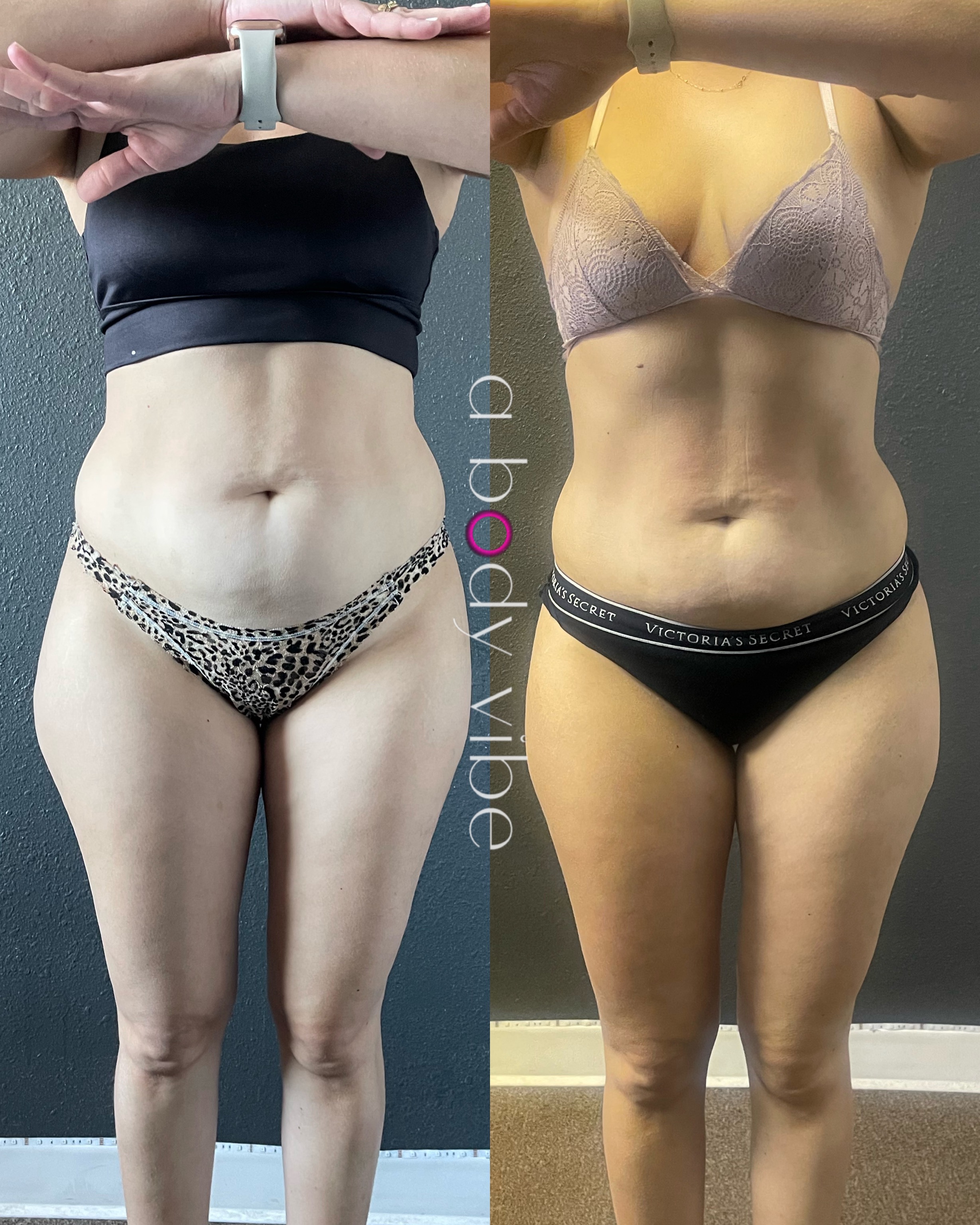 Real body contouring before and after results using cavitation and radiofrequency