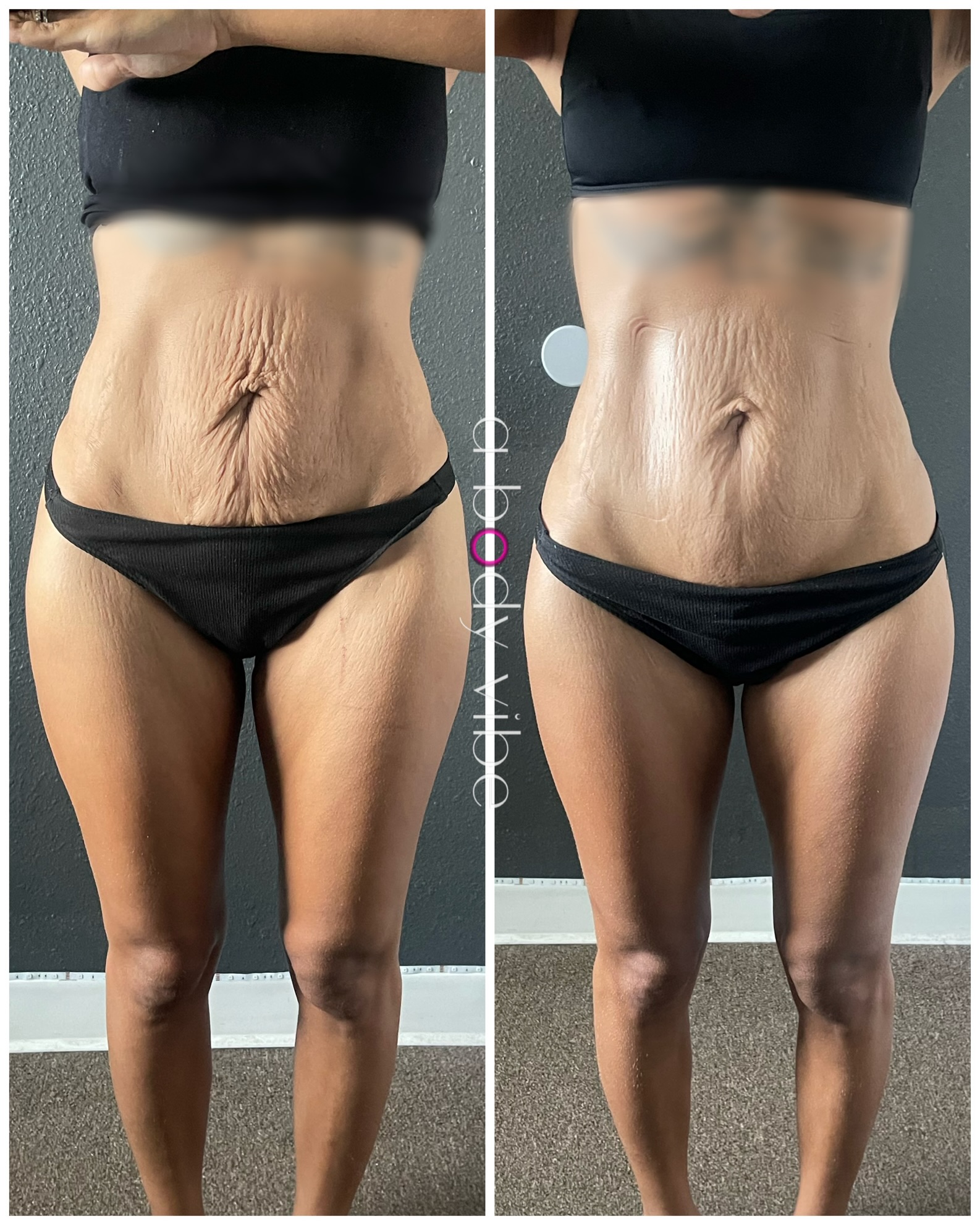 before and after results from radio frequency and wood therapy skin tightening session