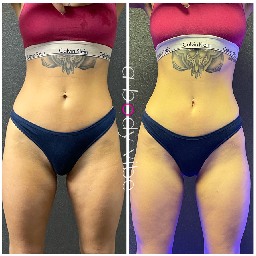 before and after results from 1 noninvasive body contouring session