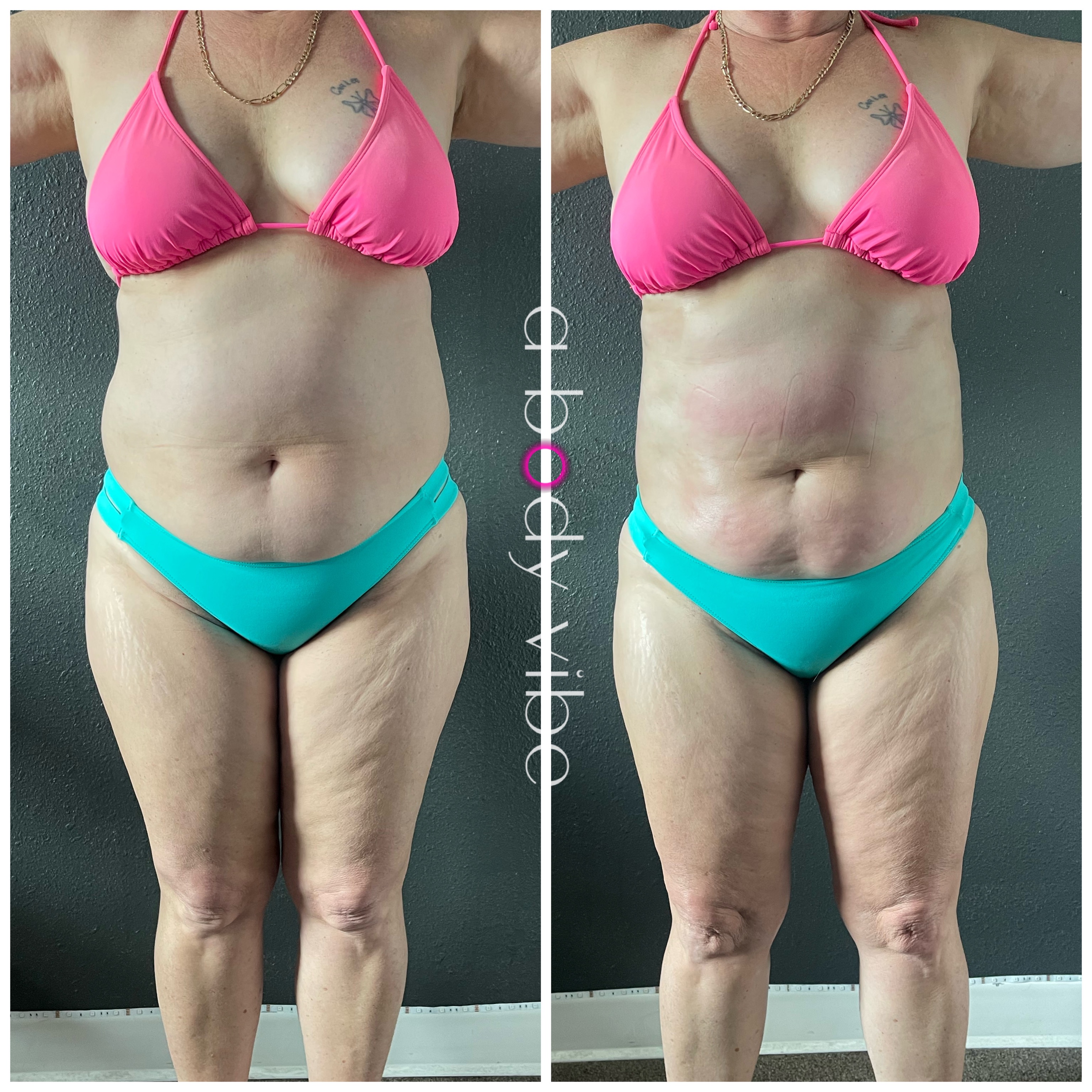 Client received 1 customized body contouring session focused on lymphatic drainage