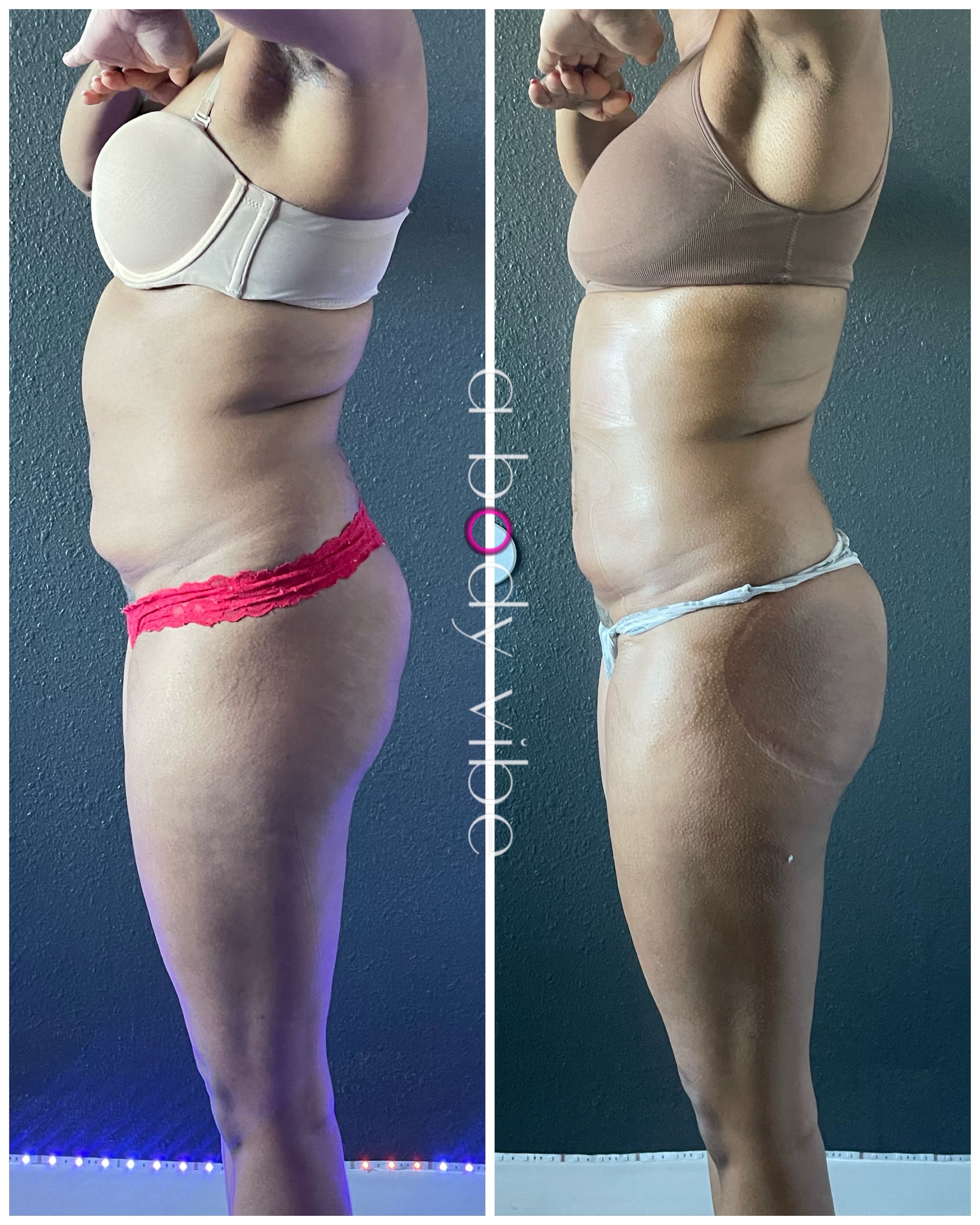 before and after results from noninvasive body contouring treatments