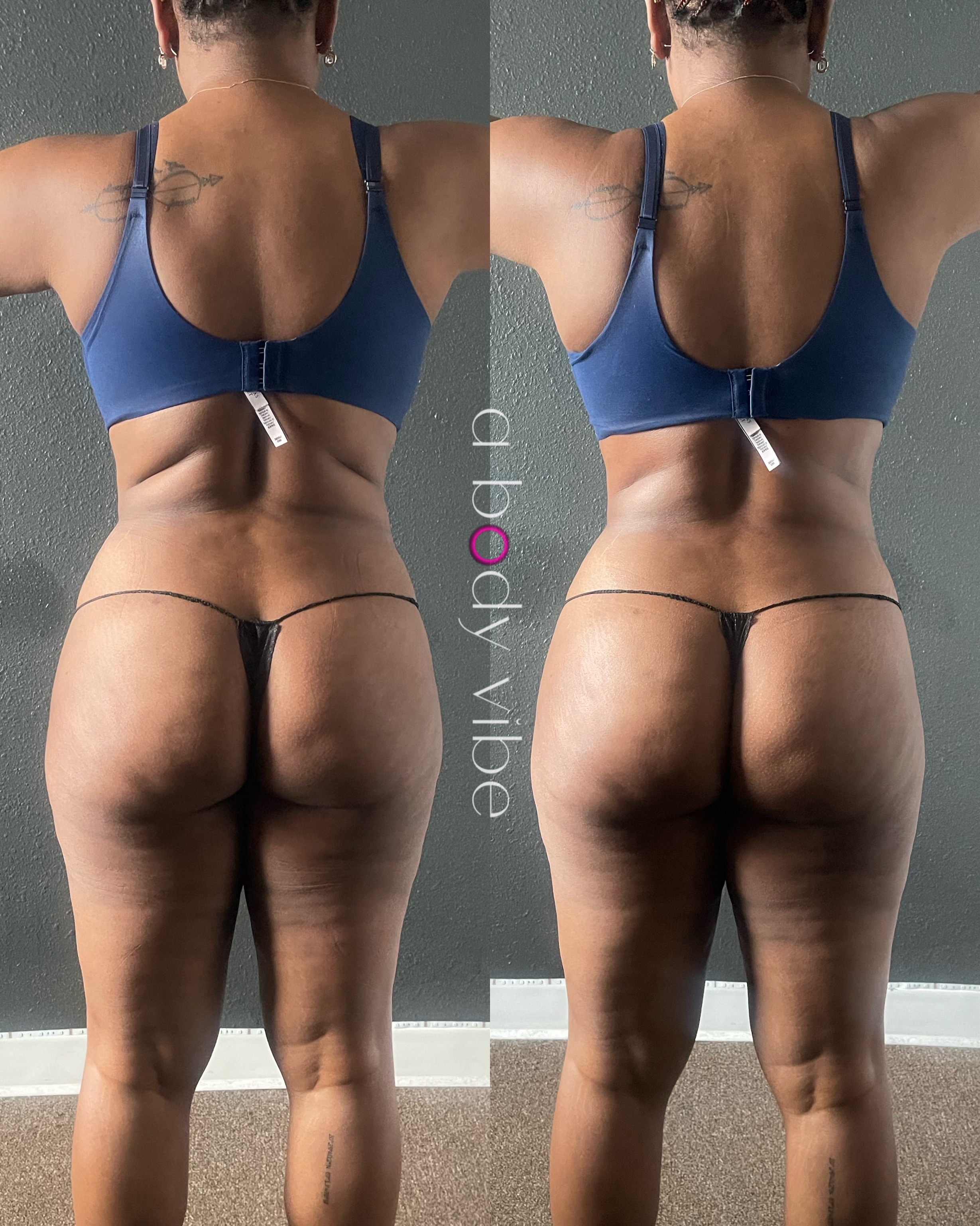 before and after results from noninvasive body contouring treatments