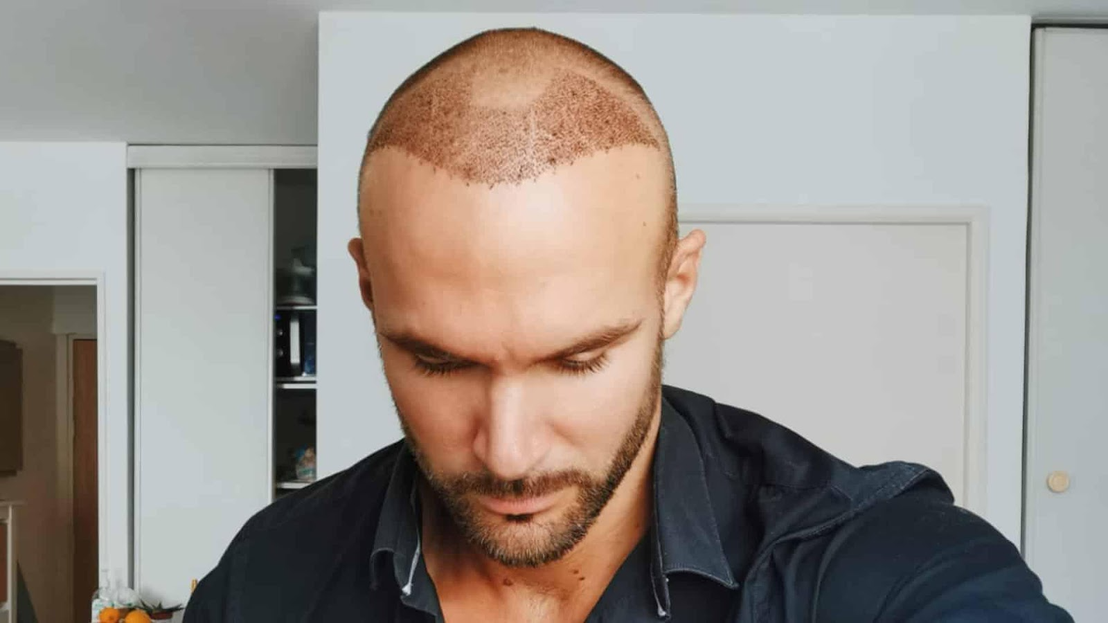 Life After Hair Transplant What Can and Cant I Do