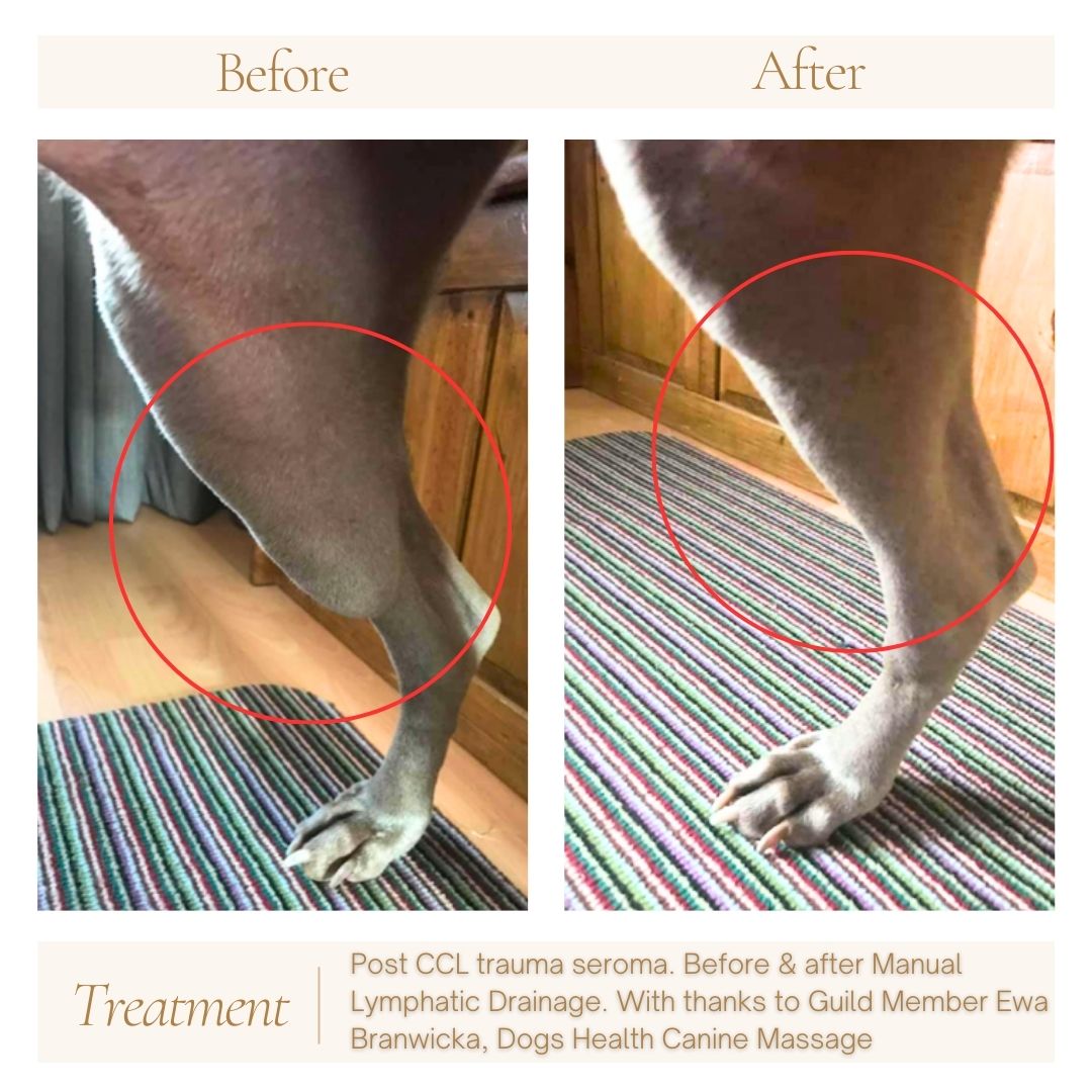 Lymphatic Seroma Before and After