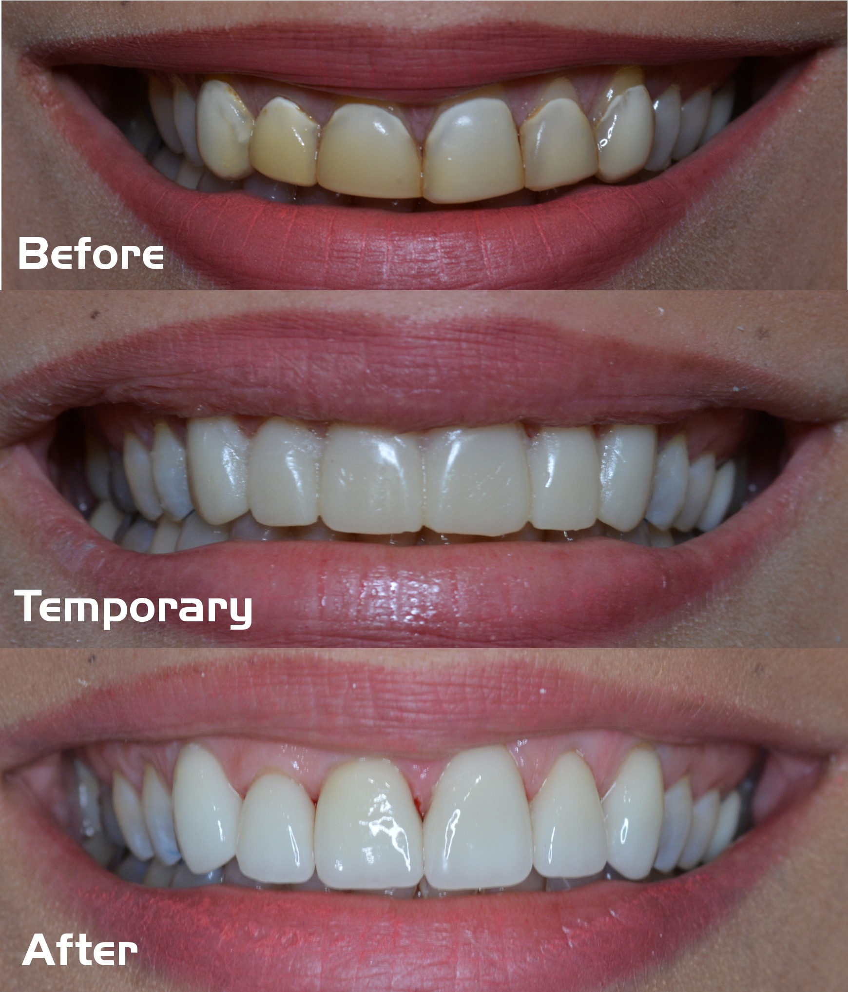 Replacement-Veneers-6-11-with-temps.jpeg